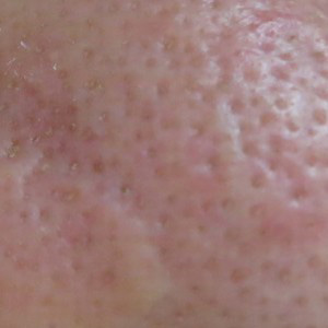 【画像アリ】鼻の毛穴対策に心血注いで6年目、黒ずみつまりと毛穴のルポルタージュ