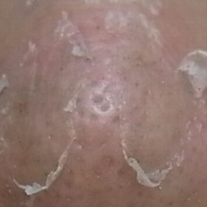 【ショック画像】鼻の毛穴を削る！　焼く！　鼻の黒ずまりと死闘を続ける櫻田の記録