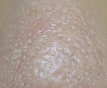 【画像アリ】汚鼻は「毛穴落ち」だらけ！　皮脂とパウダーで埋まった毛穴の禁断ルポ