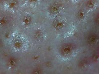 “汚毛穴”女が毛穴エステを道場破り！　重量級「角栓」VS最新テクの熱きデッドヒートルポ