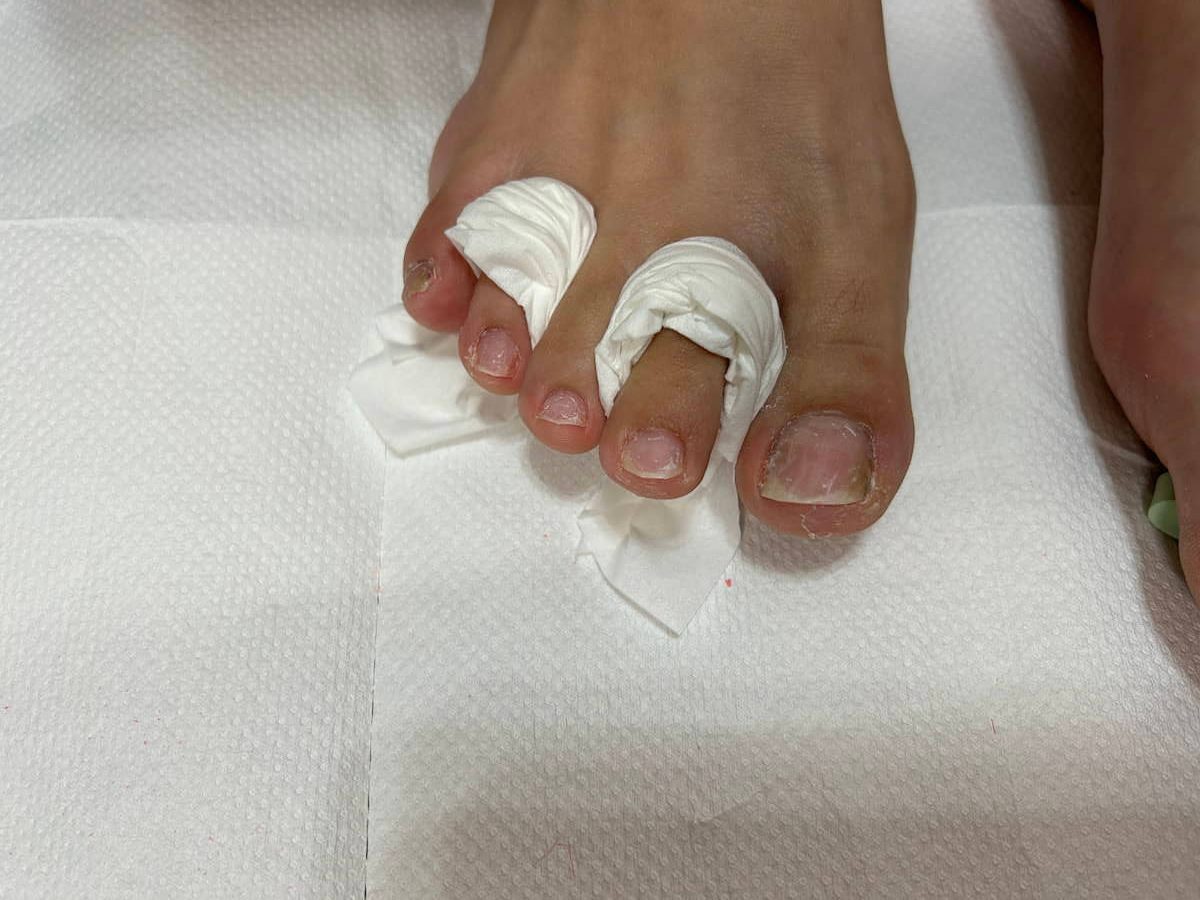 セパレーターをティッシュで代用している画像