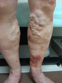 女性6人に1人がボコボコ足に……医師が警鐘、「重症むくみ＆かゆみ」の危険信号