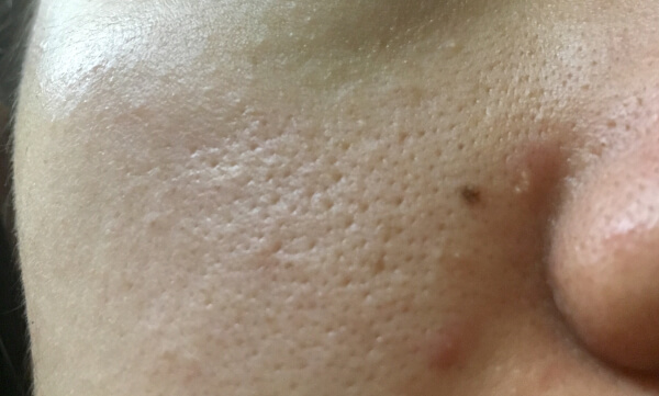 鼻より酷め？開き毛穴が多数（C）サイゾーウーマン